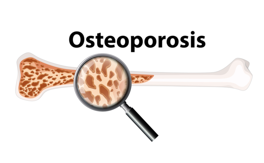 Osteoporoz Önleyici Beslenme 